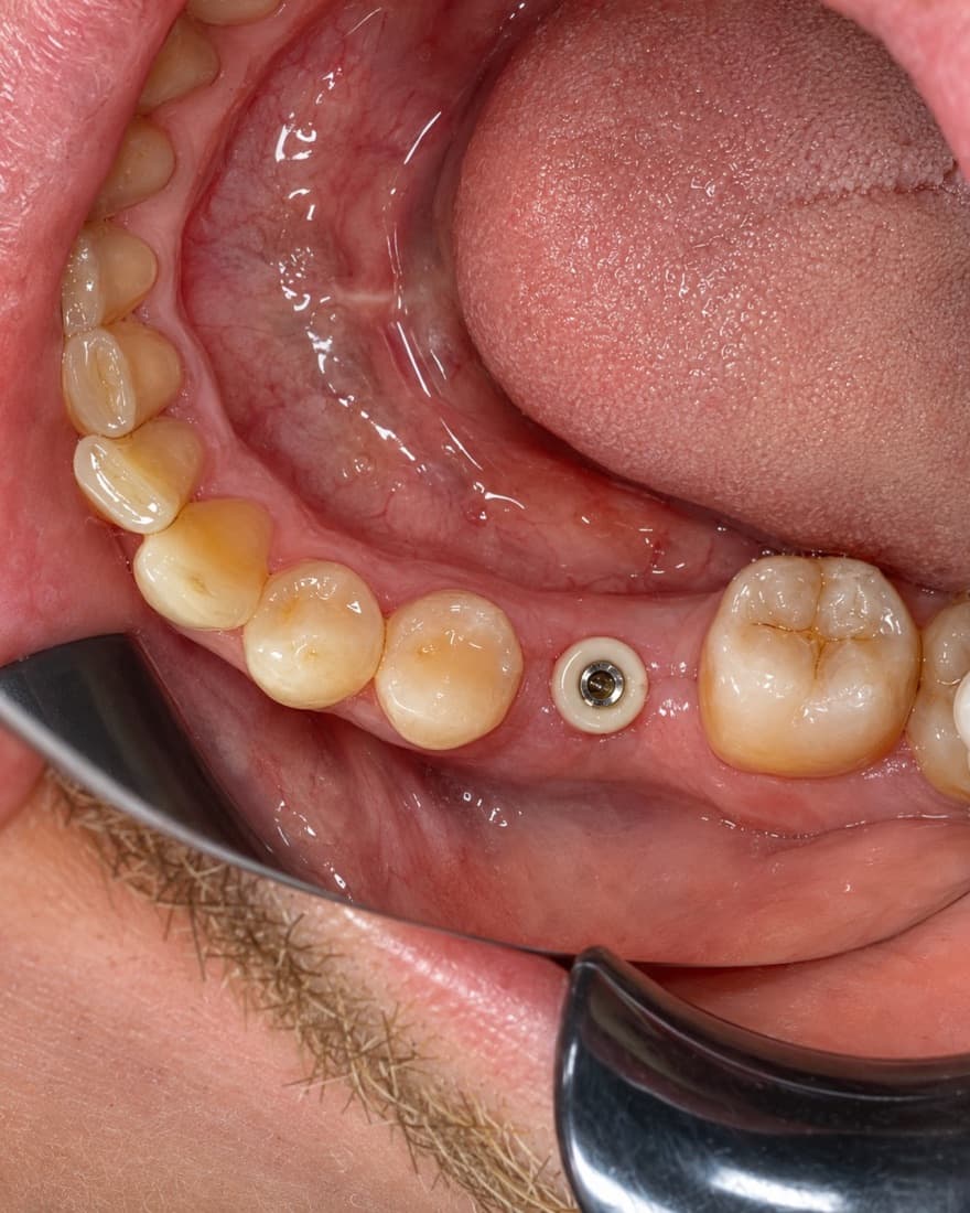 Dental Implants