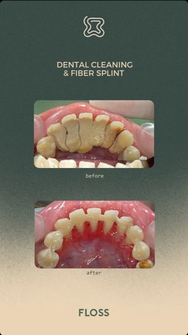 Before after dental cleaning and fiber splint treatment