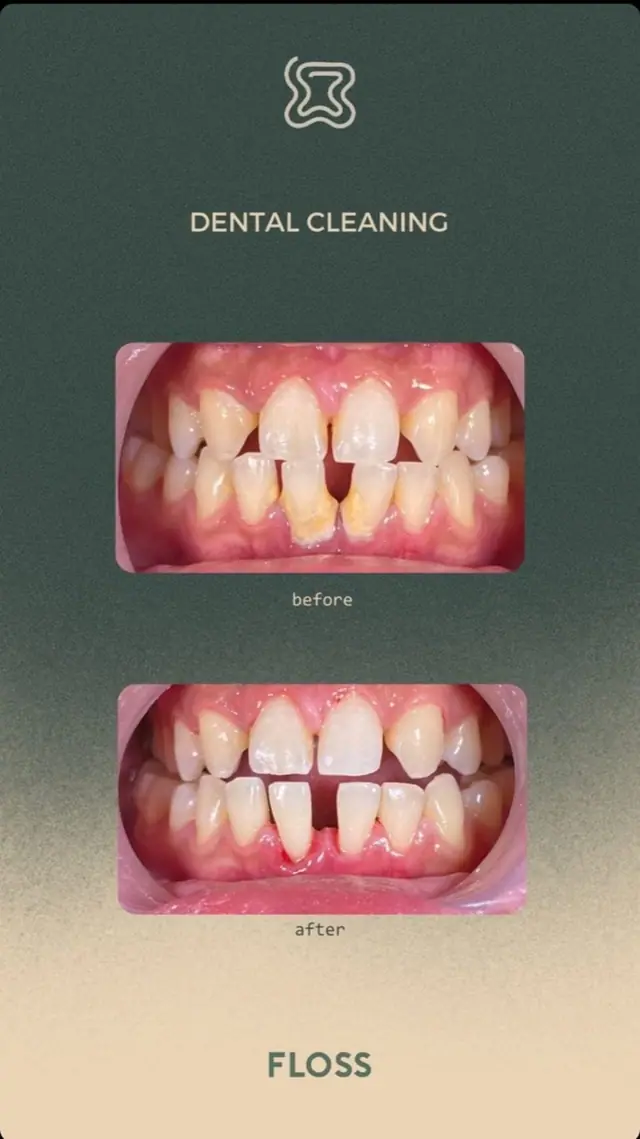 Before after dental cleaning treatment