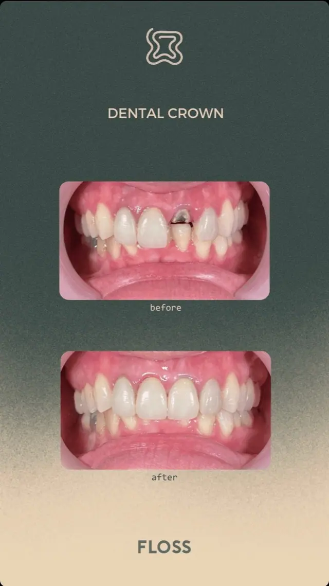 Before after dental crown treatment