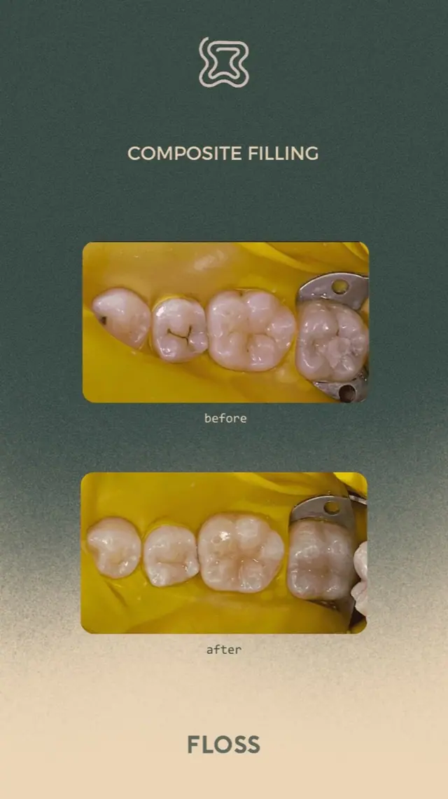 Before after composite filling treatment