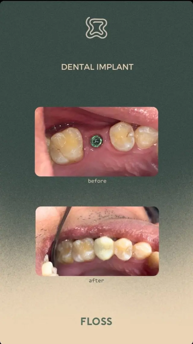 Before after dental implant treatment