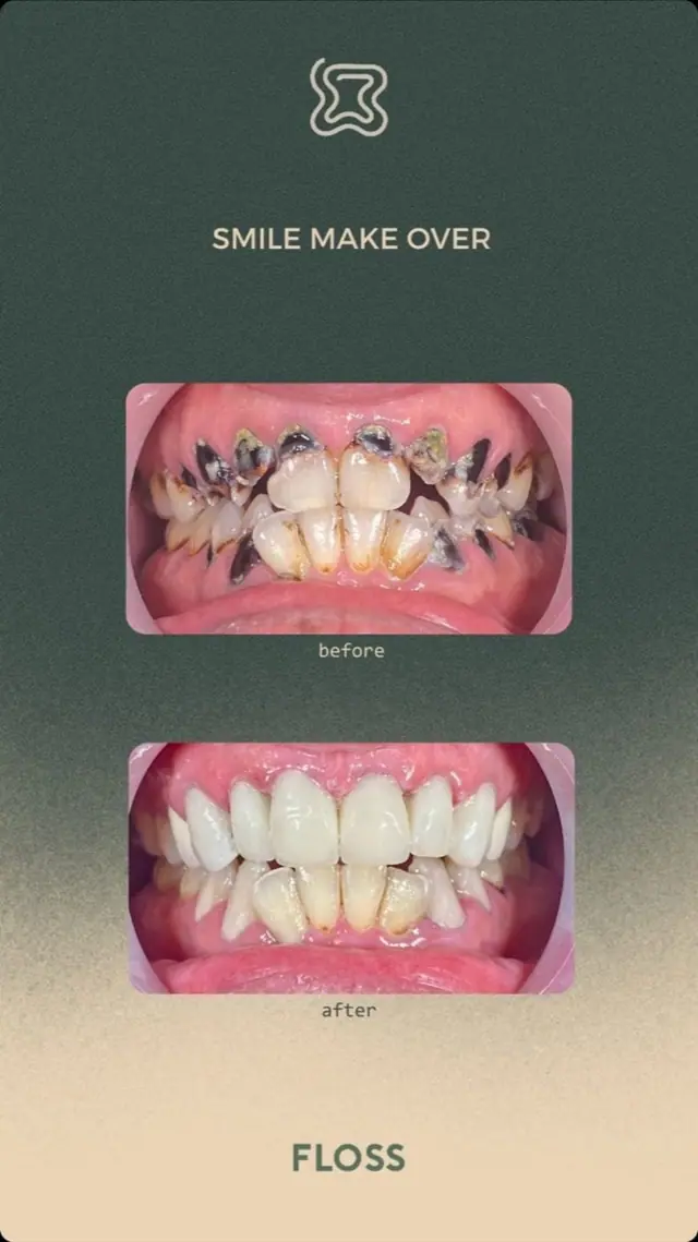 Before after smile makeover treatment