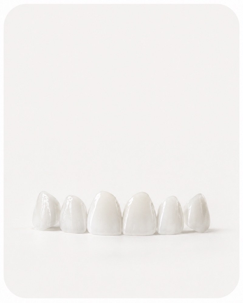 Dental veneers used in smile makeover treatment at FLOSS Dental Studio