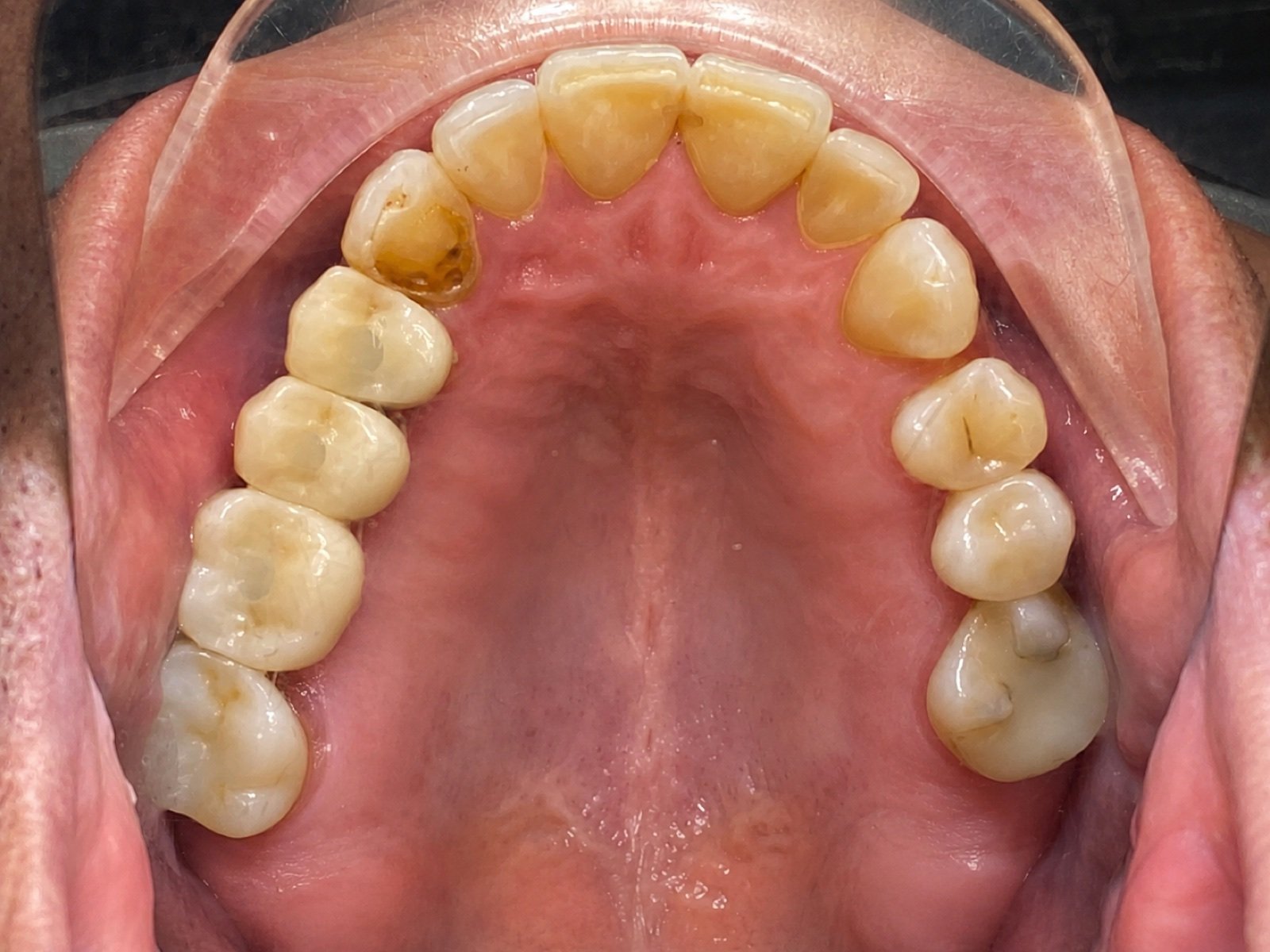 Dental Implants after treatment at FLOSS Dental Studio