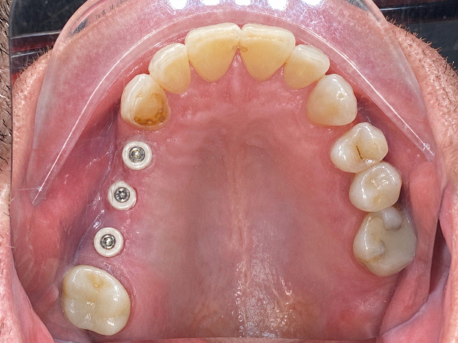 Dental Implants before treatment at FLOSS Dental Studio
