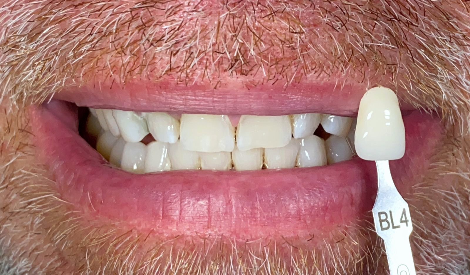 Teeth Whitening after treatment at FLOSS Dental Studio