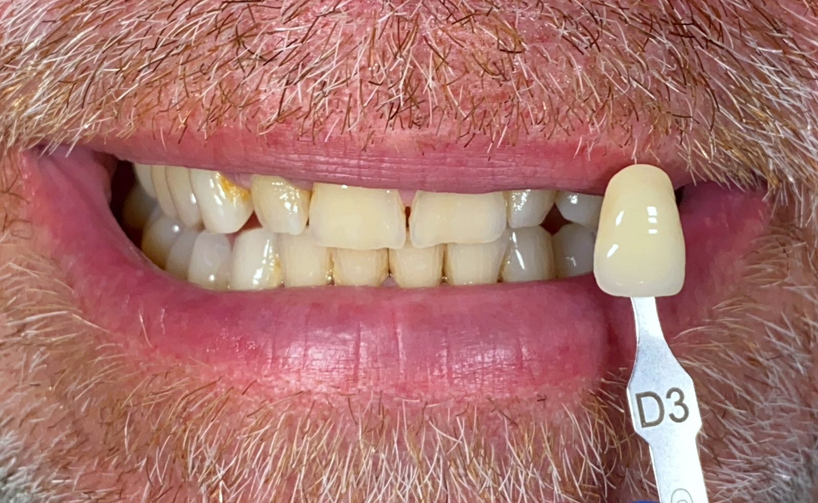 Teeth Whitening before treatment at FLOSS Dental Studio